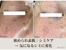レガロビューティクリエイションズ桜川店/褒められ素肌│シミケア
