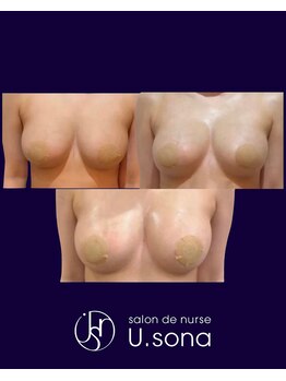 小顔・脂肪コントロール専門 salon de nurse U.sona～松本店～/【バストケア】脂肪増殖10cc