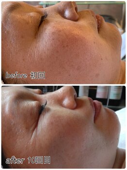 ウララ(ulala)/シミケア1回目と10回目