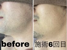 ニコ アンド キャンディー(Nico.&Candy)/ヒゲ脱毛　ビフォー＆アフター