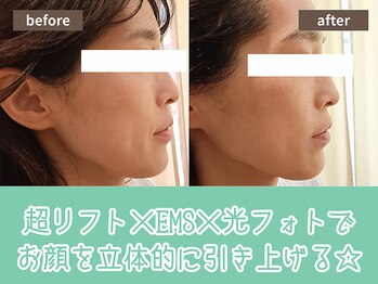 キザシ(kizashi)/最新小顔機器＆光フォト