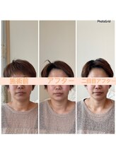 リフェイスフサエ(ReFace Fusae)/むくみが減りシャープな輪郭