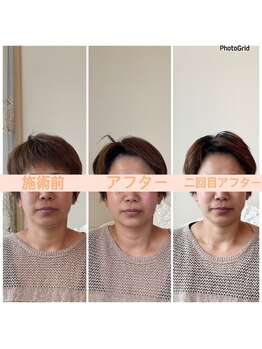 リフェイスフサエ(ReFace Fusae)/むくみが減りシャープな輪郭