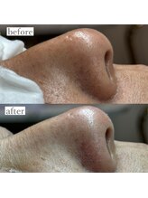 ライカブルー(RaicA BluE)/施術写真　before-after