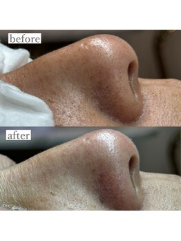 ライカブルー(RaicA BluE)/施術写真　before-after