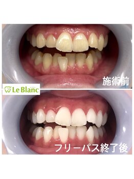 ルブラン 奈良店(Le Blanc)/ムラなく白く!