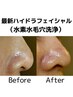 【集中毛穴ケア】ハイドラフェイシャル(水素毛穴洗浄)＋乳酸菌エクソソーム