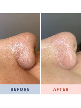 ソリス ビューティー(SOLIS BEAUTY)/毛穴洗浄