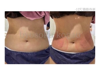 メディカルエステ 新宿南口店/*日本初-12℃脂肪冷却症例*