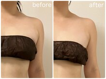 リリィブラン(Lily branc)/ブライダル/痩身/デコルテ+首肩