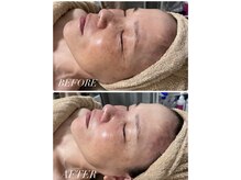 イリゼ(IRISER)/【50代】肌育ピーリング