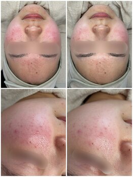 ルアンビューティー メディカルプラス(Luan beauty MEDICAL+)/ララピール×LDM×1回