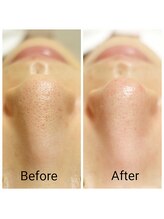 ユフラ(Yufla)/１回の施術結果