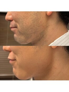 フェリーバ 流山店(FELIVA)/青髭無くして、表情も明るく♪