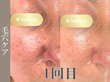 アールビューティー(R-beauty)/開き毛穴対策＋肌質改善