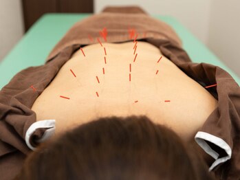 たかさきひかり鍼灸整骨院/背中の鍼