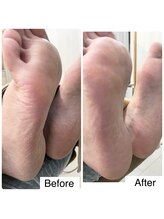 ネイルアトリエ ボン(nail atelier bon)/足裏角質ケア・パック付