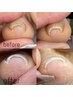 【巻き爪に悩むあなたへ】最新巻き爪ケア 親指巻き爪ケア+ジェルワンカラー
