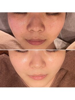 トータルエステティック ジョワイユ(JOYEUX)/☆プラズマシャワー×ジェット☆