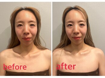 イチ(ichi)/小顔調整