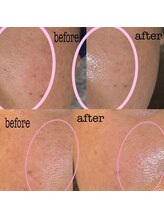 ザ レディービー(The Lady B)/毛穴ケア