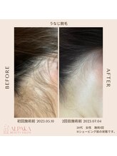 アルパカ(ALPAKA)/【うなじ脱毛】デザイン得意です