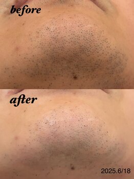 リリーミー(Rily Me)/ヒゲ脱毛