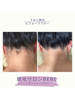ベベ(Bebe)/うなじ脱毛♪