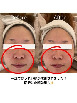 ブルーム(BLOOM)/乾燥たるみのほうれい線にも