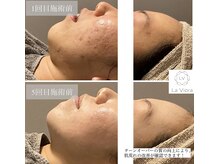 ラヴィオーラ 名駅(LaViora)/ダイヤモンドハーブピーリング