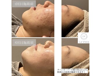 ラヴィオーラ 名駅(LaViora)/ダイヤモンドハーブピーリング