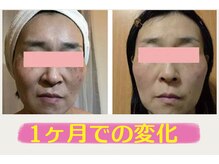 ポワトリーヌ ベル 三鷹店/ハイドロフェイシャルの効果