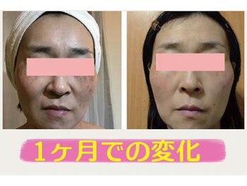 ポワトリーヌ ベル 三鷹店/ハイドロフェイシャルの効果