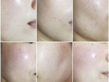 マオ(MAO)/コラーゲン導入コースで超美肌