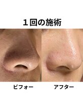 リファラ 光の森店(REFALA)/毛穴・ニキビケア専門REFALA