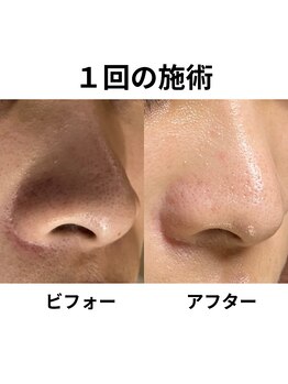 リファラ 光の森店(REFALA)/毛穴・ニキビケア専門REFALA