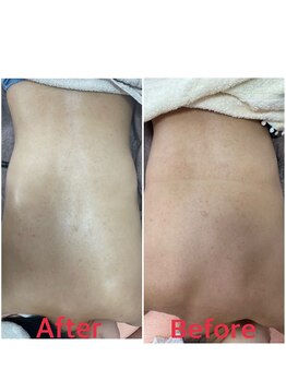 マイラサロン(MAIRA SALON)/背中のニキビお悩みの方にも