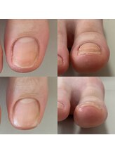 ウェルズユキ(well's yuki)/巻き爪（スカルプ長さ出し）