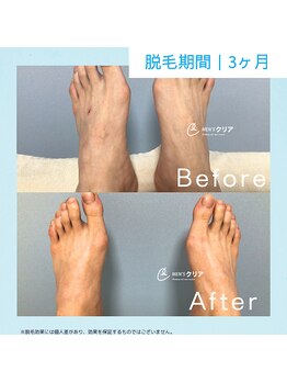 メンズクリア 八王子店/【メンズクリア】お客様の施術例