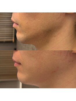 フェリーバ 流山店(FELIVA)/6ヶ月で髭剃りのいらない生活へ