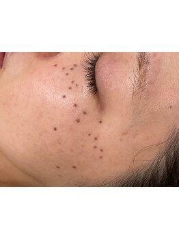 シミしわ改善！予防ケア