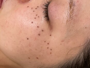 シエナ(ciena)の写真/濃いシミも薄いシミも徹底ケア!当日メイクOK&テープ貼付なし《エイジングケア+シミケア30分》70分6800円