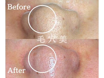 毛穴美/自分で取れない毛穴汚れ