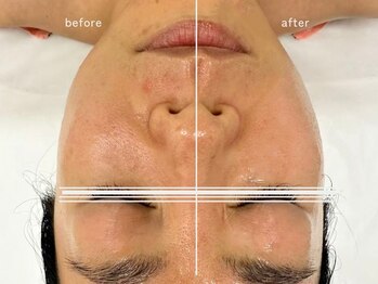 洗顔サロン 池袋(SENGAN)/美点でやさしく流して引き上げる