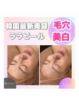 ホワイトアクア 加古川店(WHITE AQUA)/ララピール/兵庫/加古川/毛穴