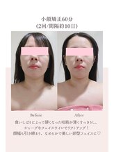 トゥインクル 麻布(twinkle)/麻布十番/シンメトリー小顔矯正