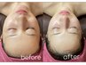 4月限定【小顔×美肌】インディバfacial60分×エクソソームハーブピーリング