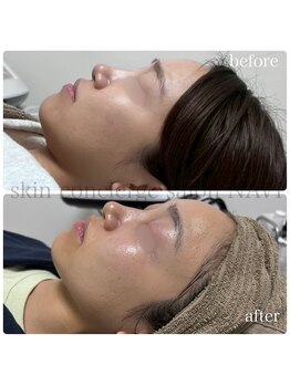 ナビ(NAVI)/ピーチリフトでたるみ改善！