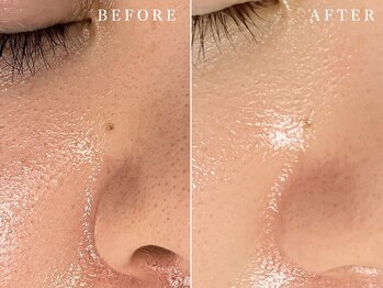 ビビ(BiBi)の写真/毛穴のざらつき気になる肌に◎透明感UP！産毛ケアもできる贅沢糸エステでつる艶ゆで卵肌へ◎