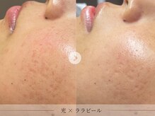スパレーカ(Spa laka)/凹凸・色むらケア